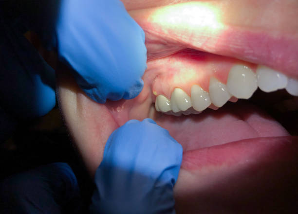 Best Emergency Treatment for Dental Infections or Abscesses in Manchaca, TX